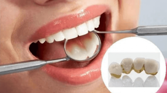 Bọc răng sứ kim loại thường có tốt không?