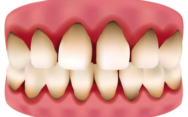 Răng sứ kim loại thường có chi phí khá rẻ
