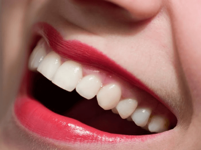 Răng sứ Titan tương hợp sinh học cao