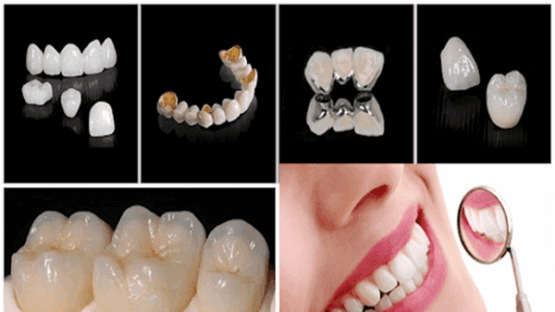 [Tư vấn của chuyên gia] Răng sứ Titan sử dụng được bao lâu?