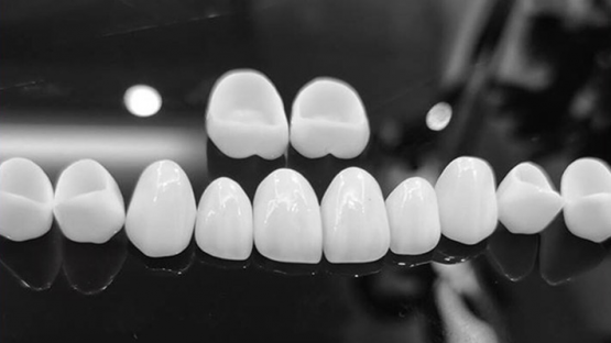 Nha Khoa Kim – Địa chỉ uy tín để sở hữu hàm răng sứ zirconia razor