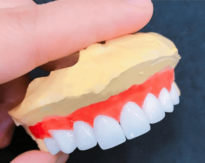Răng toàn sứ Venus Multi: Địa chỉ và quy trình thực hiện bọc răng sứ
