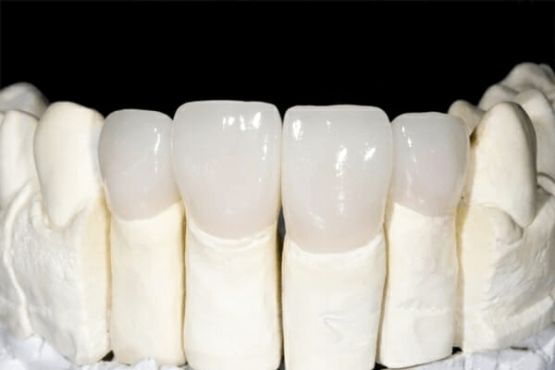 Địa chỉ bọc răng toàn sứ Venus Multi chất lượng hàng đầu hiện nay