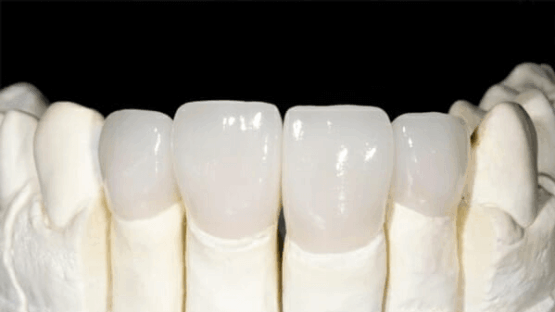 Địa chỉ bọc răng toàn sứ Venus Multi chất lượng hàng đầu hiện nay