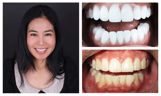 Ưu nhược điểm và quy trình bọc răng toàn sứ Lava Plus tại Nha khoa Kim