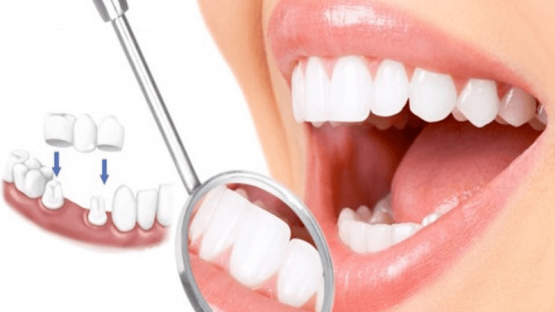 So sánh răng sứ Zirconia và Katana: nên chọn bọc răng sứ loại nào?