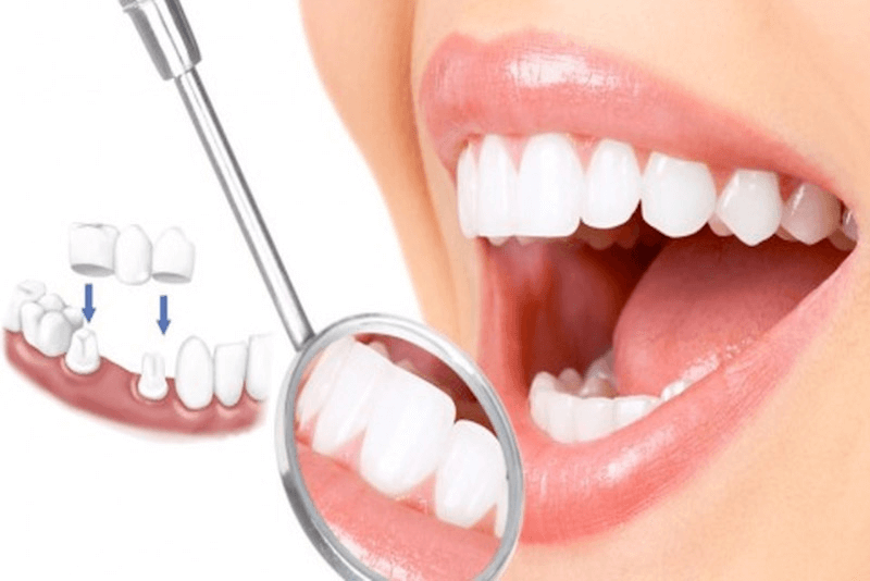  Răng sứ katana - Hướng dẫn chọn răng sứ phù hợp với bạn