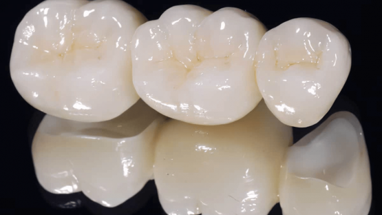 Dịch vụ bọc răng sứ Zirconia Crystal chất lượng tại Nha Khoa Kim