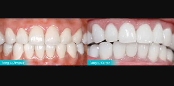 So sánh răng sứ Zirconia và Cercon & Những kiến thức cần biết