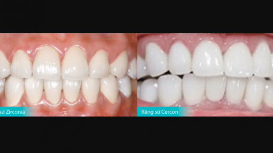 So sánh răng sứ Zirconia và Cercon & Những kiến thức cần biết