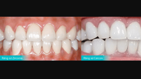 So sánh răng sứ Zirconia và Cercon & Những kiến thức cần biết