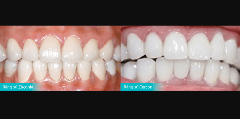 Điểm tương đồng giữa răng sứ Zirconia và Cercon