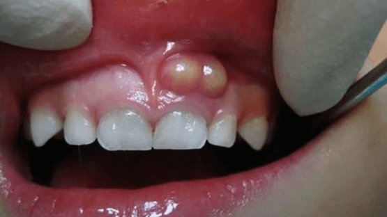 Sưng nướu răng: Nguyên nhân và cách điều trị