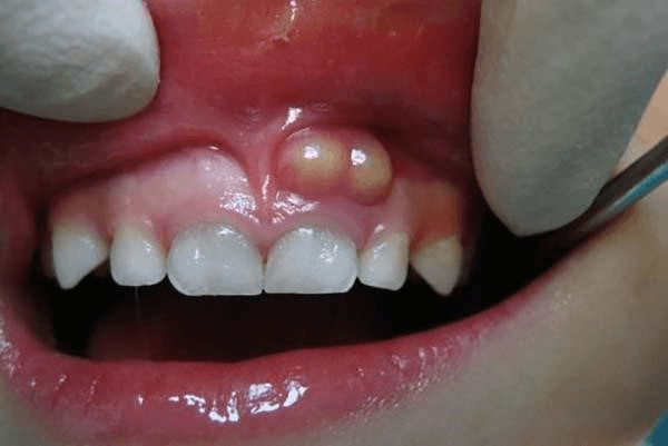 Quá trình phát triển của sâu răng và các dấu hiệu nhận biết sớm?
