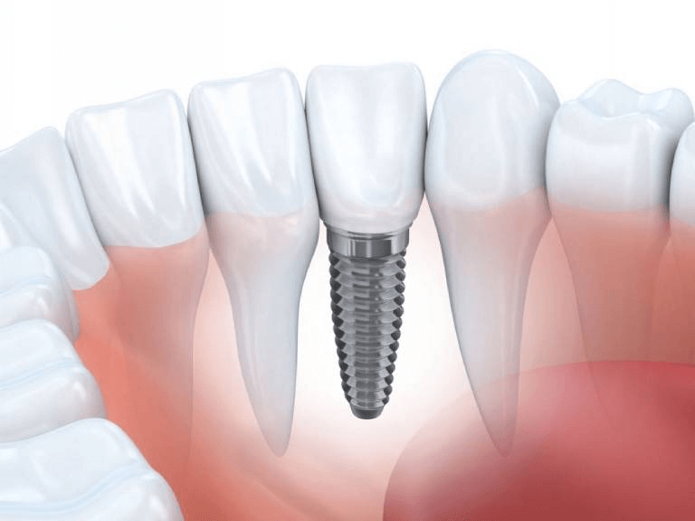 Cấy ghép implant tức thì cần có điều kiện gì?