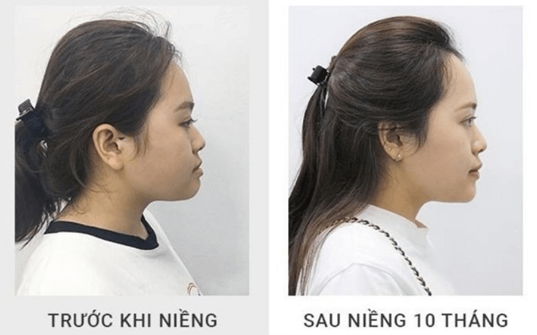 Thay đổi hình dáng khuôn mặt trước và sau khi niềng răng