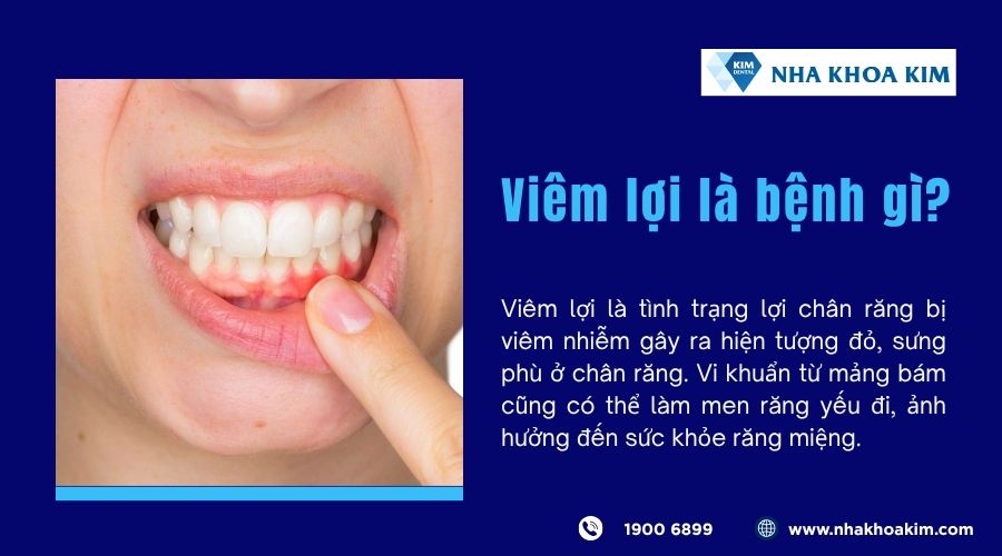 Viêm lợi là bệnh gì?