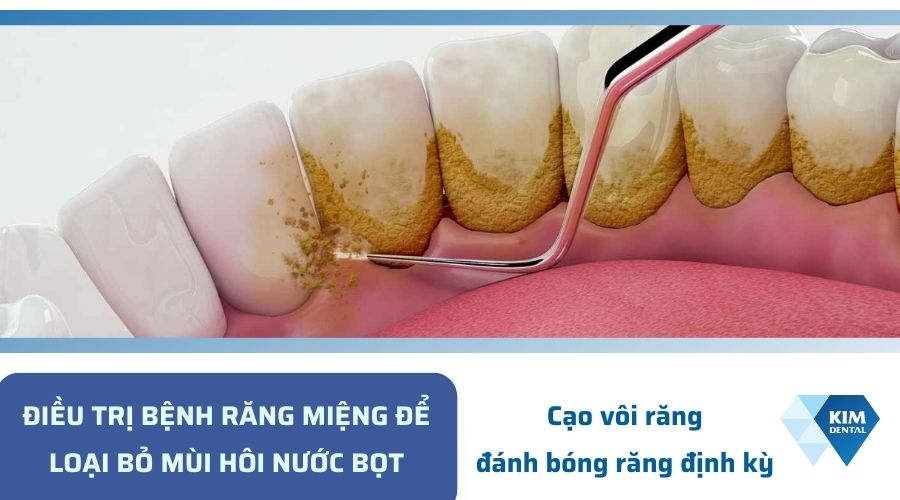 Cạo vôi răng giúp cải thiện tình trạng hôi miệng