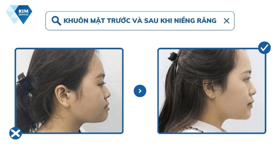khuôn mặt trước và sau niềng răng