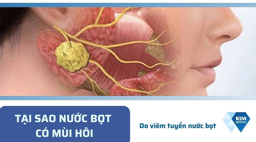 Nguyê nhân nước bọt có mùi hôi
