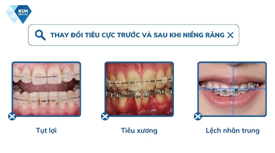 thay đổi tiêu cực sau niềng răng