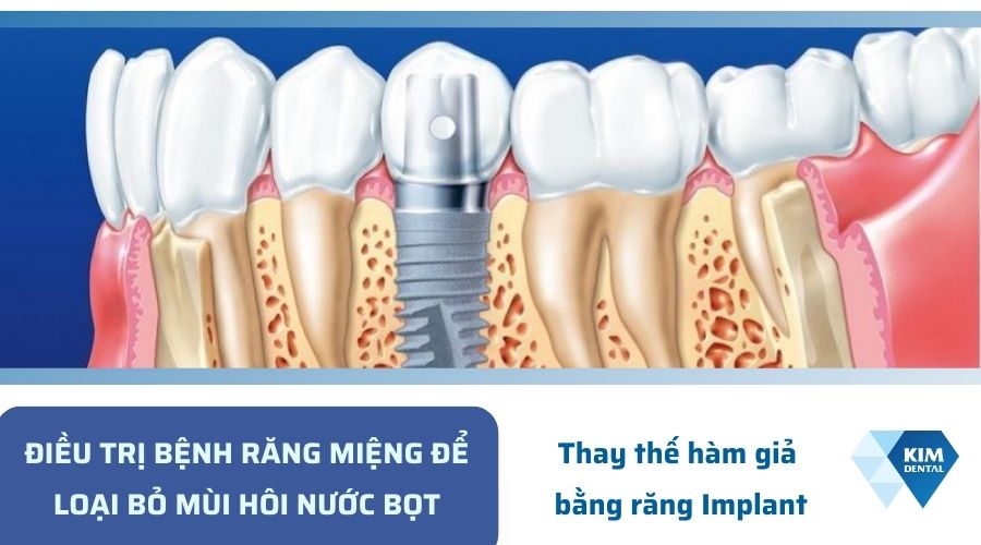 Trồng răng Implant giúp cải thiện nước bọt có mùi hôi