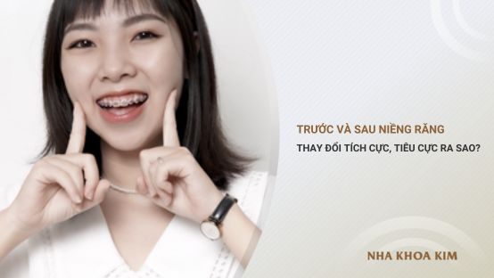 Trước và sau khi niềng răng thay đổi tích cực và tiêu cực ra sao?