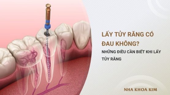 Lấy tủy răng có đau không? Những điều cần biết khi lấy tủy răng