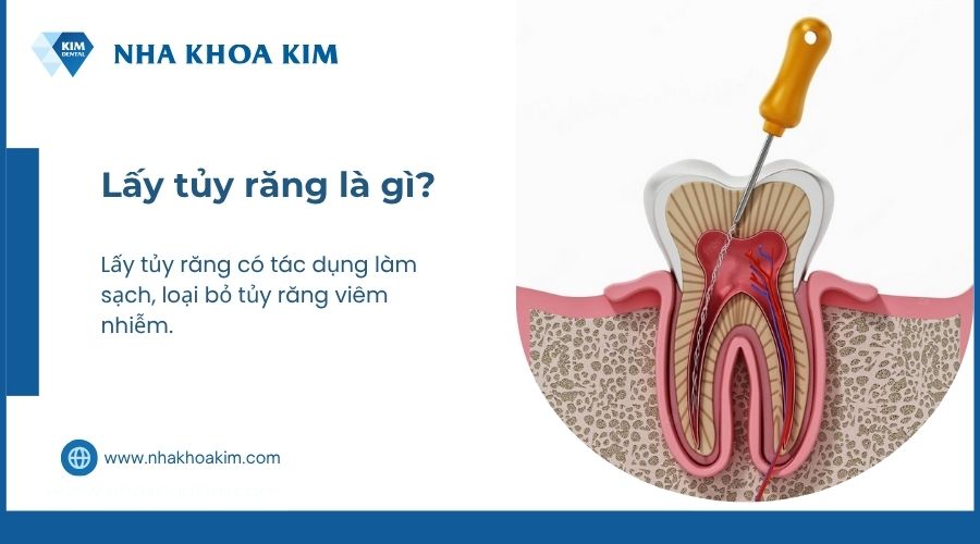 lấy tủy răng là gì
