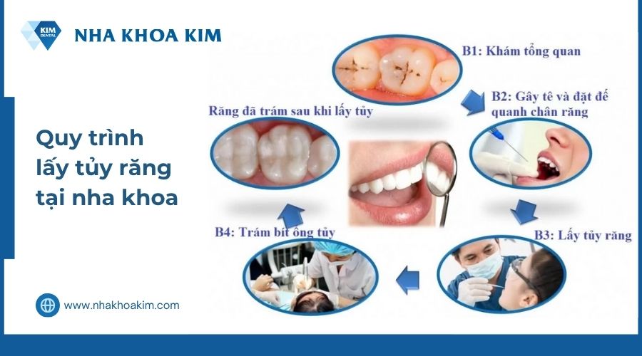 quy trình lấy tủy răng có đau không tại nha