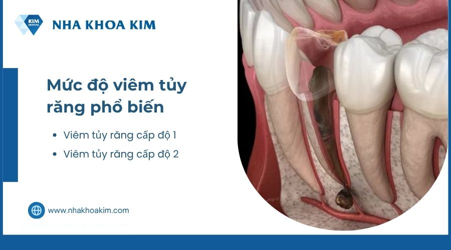 mức độ viêm nhiễm tủy răng