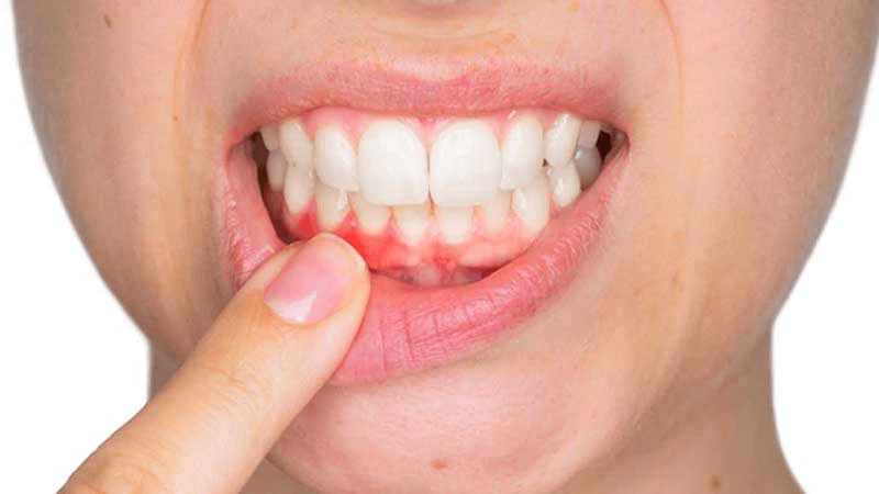 Sâu răng không điều trị dứt điểm gây nên nổi cục cứng