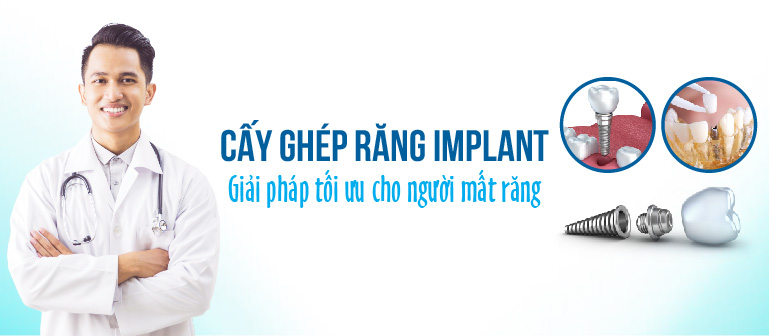 [Top Banner Mobile] Trồng răng Implant – Giải pháp phục hình răng hoàn hảo