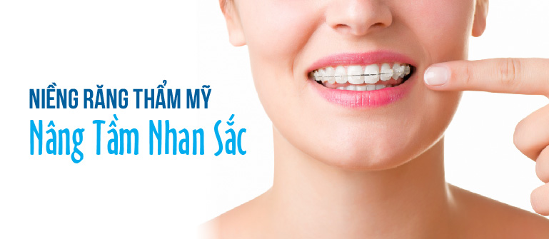 Niềng răng – Giải pháp tối ưu cho hàm răng đều, nụ cười đẹp