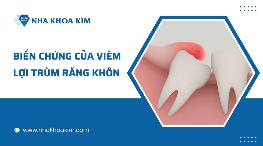 Viêm lợi trùm răng khôn có nguy hiểm không?