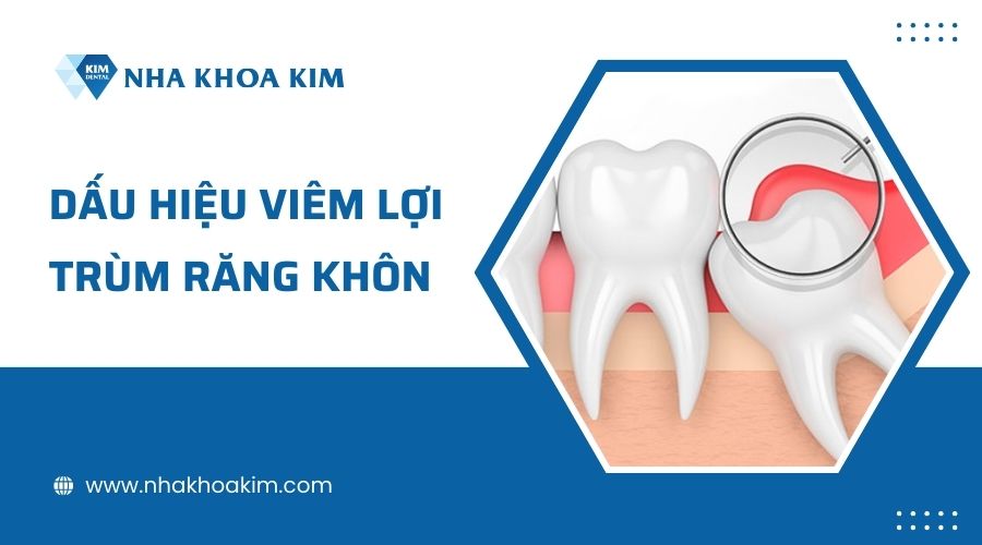 Dấu hiệu viêm lợi trùm răng khôn