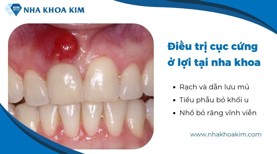 Điều trị cục cứng ở lợi