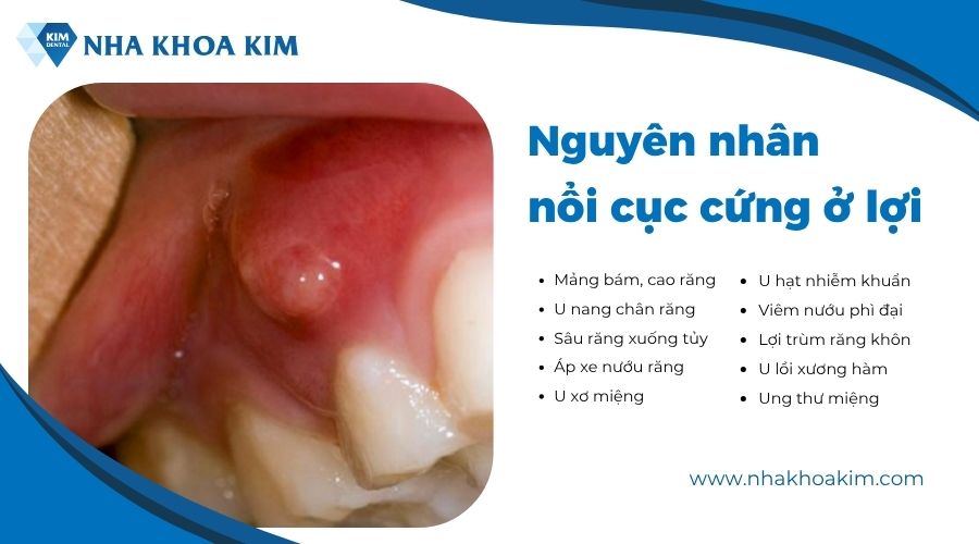 nguyên nhân nổi cục cứng ở lợi