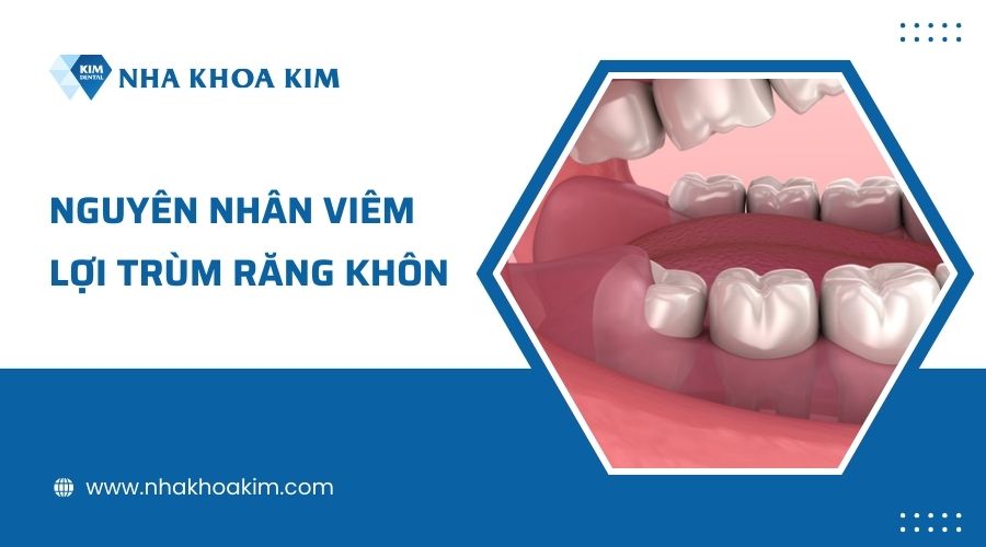 Nguyên nhân gây viêm lợi trùm răng khôn?