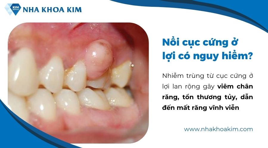 Lợi bị nổi cục cứng có nguy hiểm không