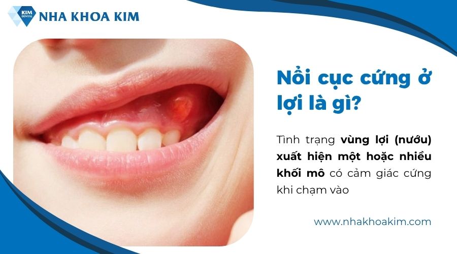 nổi cục cứng ở lợi là gì
