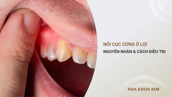 Nổi cục cứng ở lợi: Tìm hiểu nguyên nhân và giải pháp điều trị