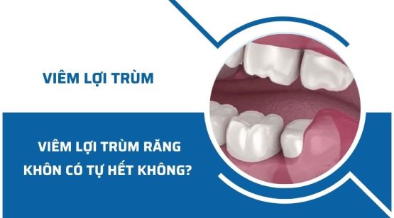 Viêm lợi trùm răng khôn có tự hết không? Cách điều trị dứt điểm bệnh