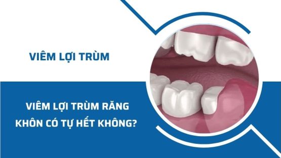 Viêm lợi trùm răng khôn có tự hết không? Cách điều trị