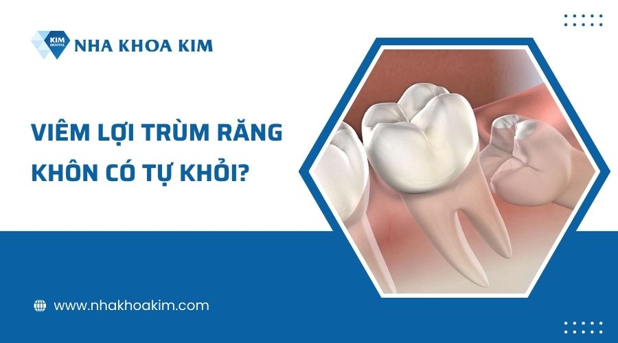 Viêm lợi trùm răng khôn có tự hết được không?