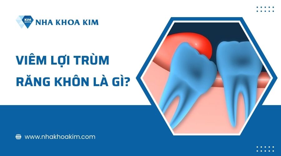 Viêm lợi trùm răng khôn là gì?