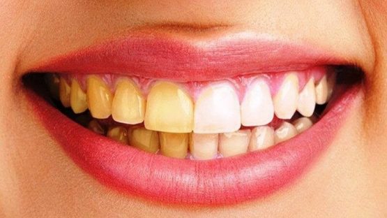 Cách làm trắng răng bị ố vàng ngay tại nhà đơn giản và nhanh chóng