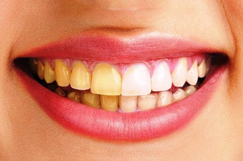 Có nhiều nguyên nhân khiến răng bị ố vàng