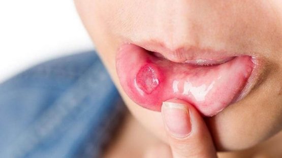 Tìm hiểu các cách trị lở miệng cực kỳ hiệu quả ngay tại nhà