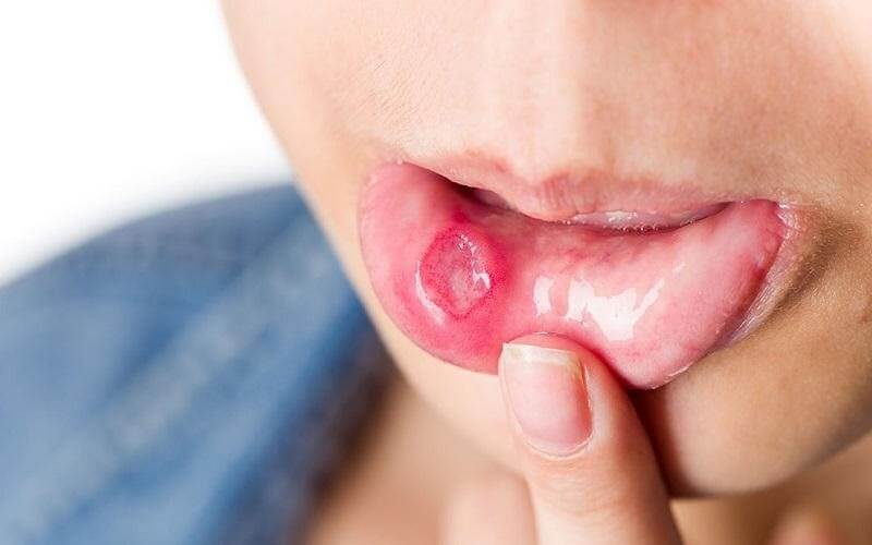 Nguyên nhân và cách trị lở miệng cực kỳ hiệu quả ngay tại nhà